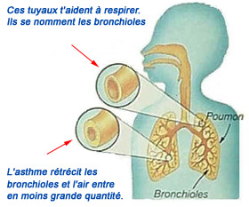 Asthme