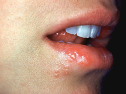 Infection orale par l'herps