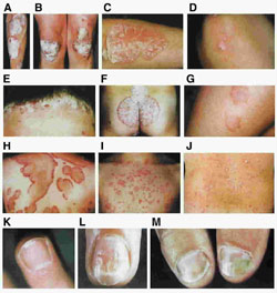 Psoriasis