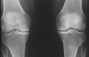 arthrose calcification du genou. Photographie source http://www.med.univ-rennes1.fr